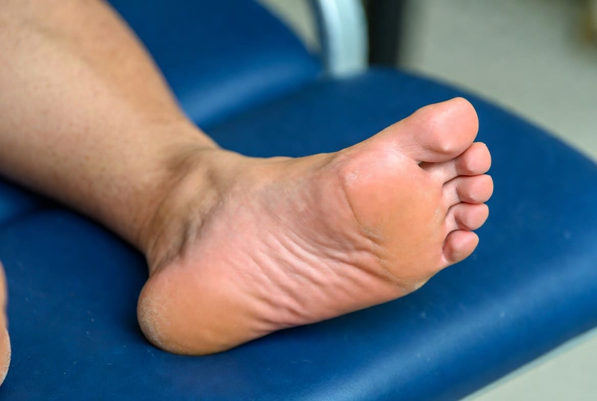 Corns and calluses before treatment