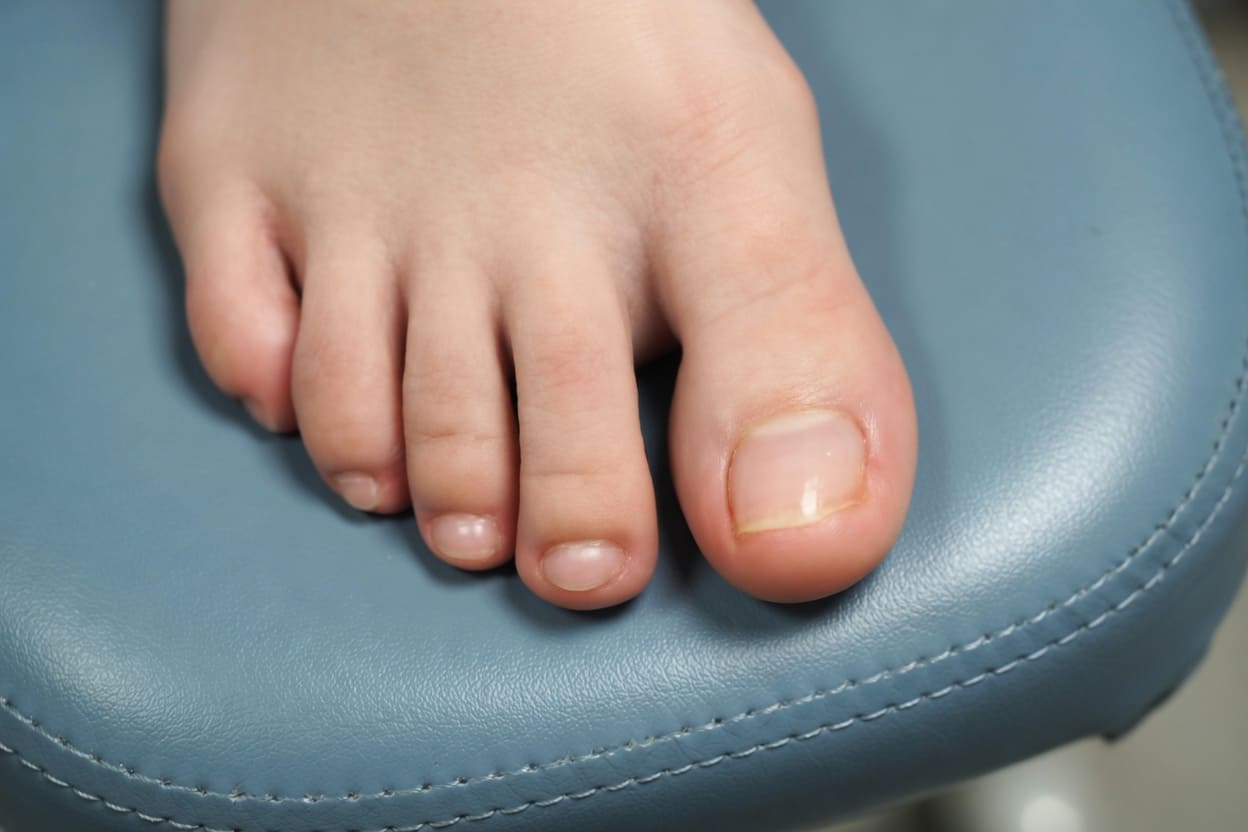 Ingrown toenail after treatment