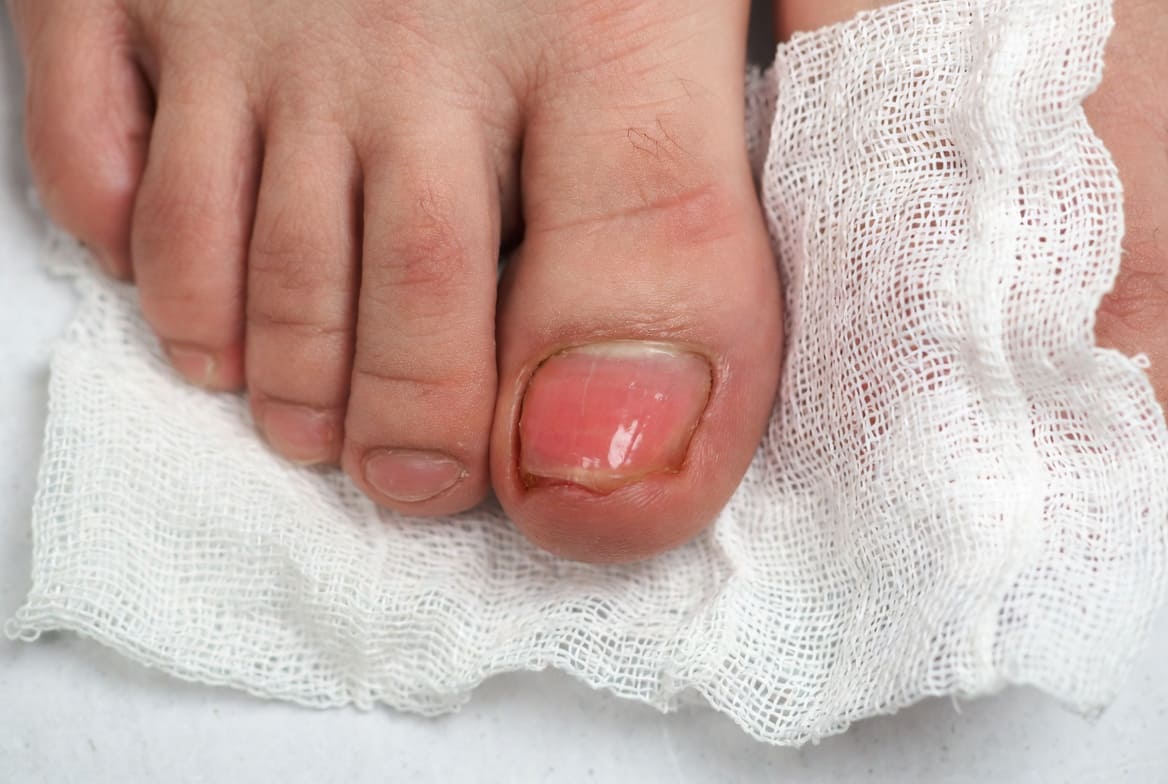 Ingrown toenail before treatment