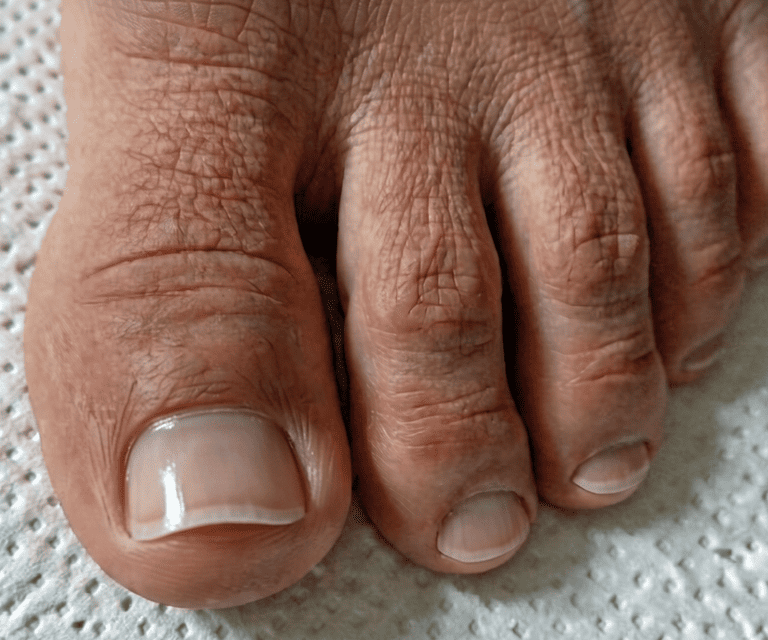 Toenail fungus after treatment