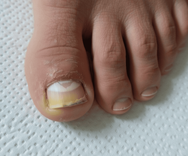 Toenail fungus before treatment